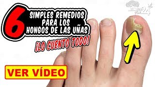 COMO ELIMINAR LOS HONGOS DE LAS UÑAS DE LOS PIES Y MANOS CON ESTOS SIMPLES REMEDIOS CASEROS [upl. by Clementas]