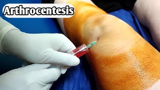 شاهد كيف يتم سحب سوائل الركبة  Knee fluid removal  Arthrocentesis  Synovial fluid aspiratio [upl. by Ednargel]