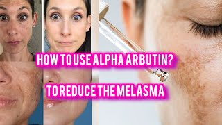 Melasma Treatment skincare routine with alpha arbutin [upl. by Anoi]