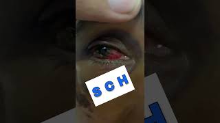 Subconjunctival Hemorrhage Part 4 Shorts SubconjunctivalHemorrhage [upl. by Niamjneb]