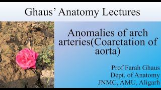 Coarctation of aorta [upl. by Erehpotsirhc847]