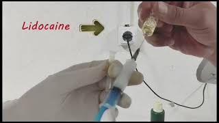 Remove abdominal fluid ascites Ascitic fluid aspirationascitesliver Cirrhosisheartfailure [upl. by Hardy]