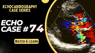 ECHO CASE 74  Echocardiography spot diagnosis Series  Echocardiogram Reporting  Echo Board [upl. by Yrtua]