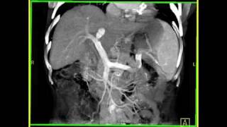 Abdomen Liver Cirrhosis 3D Volume rendering of a cirrhotic liver with collaterals [upl. by Cozmo150]