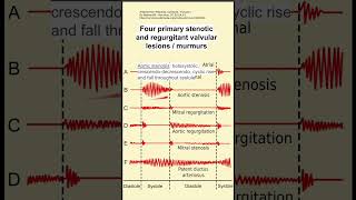 Four primary stenotic and regurgitant valvular lesions  murmurs [upl. by Amahcen441]