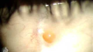 Pyogenic Granuloma on Eye [upl. by Eledoya]