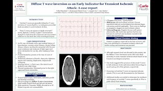 Diffuse T wave Inversions in TIA [upl. by Konstantin83]