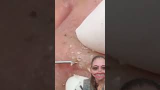 Blackheads Removal  Acne Treatment and Very Satisfying Satisfying Pimple pop blackheads [upl. by Idell797]