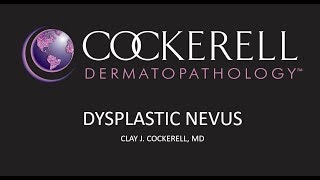 Dysplastic Nevus  Cockerell Dermatopathologys Beliefs [upl. by Romeyn501]