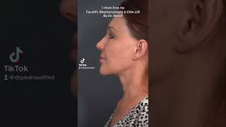 Facelift Bepharoplasty and Chin Lift  One Week PostOp  Dr Paul Nassif [upl. by Erine532]