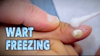 FREEZING WARTS With Sizzling Liquid Nitrogen  Dr Paul [upl. by Thorma999]