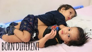 The Conjoined Twin Brothers Who Survived Separation  BORN DIFFERENT [upl. by Rybma]