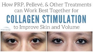 How Pelleve and PRP Work Differently to Generate Collagen and Improve Skin Texture and Quality [upl. by Cocke]