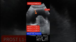 Ultrasound showing Enlarged prostateprostatomegaly ultrasound [upl. by Dragon]