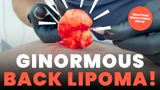 GINORMOUS BACK LIPOMA REACTIONEDUCATIONAL RECAP [upl. by Bokaj]