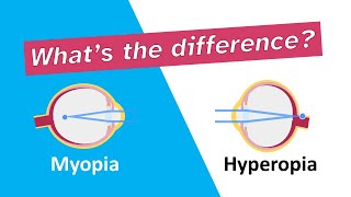 Whats the difference between myopia nearsightedness and hyperopia farsightedness [upl. by Atiral]