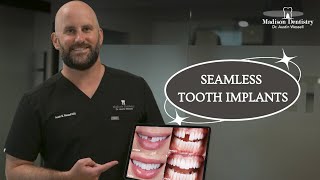 Seamless Tooth Implants [upl. by Eveline]