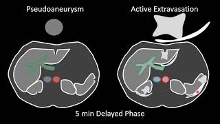 Blunt Abdominal Trauma Part 1 Vascuary Injury [upl. by Alaine33]