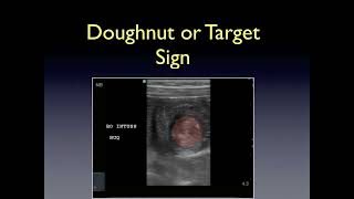 Bedside Ultrasound Diagnosis of Pediatric Intussusception [upl. by Welford74]