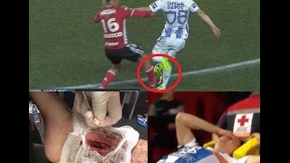 Terrible Lesión del CHUCKY Lozano  Horrible Injury [upl. by Collin]