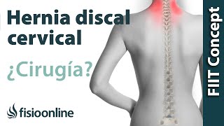 Hernia Discal Cervical cuándo optar por la cirugía u operación quirúrgica [upl. by Tamarra299]