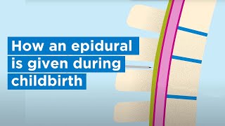 How an epidural is given during childbirth  Bupa Health [upl. by Elisabeth]