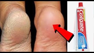 Get Rid of CRACKED HEELS Permanently Magical Cracked Heels Home Remedy फटी एड़ियों का घरेलू नुस्खा [upl. by Andres]