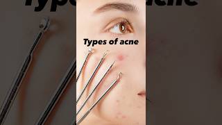 Types of acne acneskincarebeauty acneproneskin [upl. by Amari]