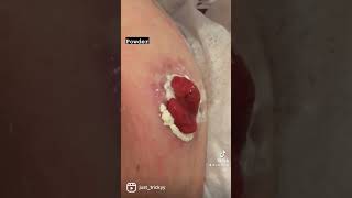 Stoma care ileostomy skin help [upl. by Ayot]