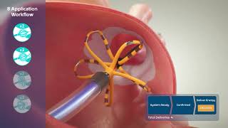 FARAPULSE™ Pulsed Field Ablation System Animation [upl. by Nnasor]