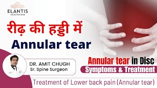 What is Annular tear l Annular Tear Disc l Annular Tear Treatment l Lower Back Pain  Dr Amit Chugh [upl. by Lemire]