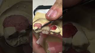 Splint removal viralvideo dentistryworld dentaltreatment shortsvideo shortsfeed dentisty [upl. by Htaek241]