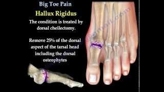 Big Toe Pain  Everything You Need To Know  Dr Nabil Ebraheim [upl. by Nuj]