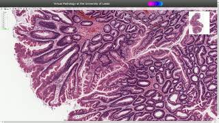 Traditional Serrated Adenoma  Histopathology [upl. by Alaehcim]