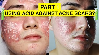 USING ACID TO GET RID OF ACNE SCARS  My TCA CROSS Experience Philippines  Envi Beauty Part 1 [upl. by Ahsa]