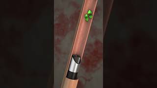 lithotripsy Animation shorts viralshorts [upl. by Davidoff120]