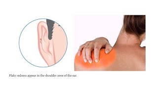 FACE READING FOR FROZEN SHOULDER ADHESIVE CAPSULITIS [upl. by Grizelda]