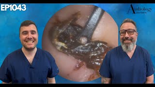 OPERA SINGERS STICKY EAR WAX REMOVAL  EP1042 [upl. by Ecahc]