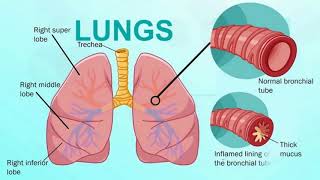 Difference Between Bronchitis and Bronchiectasis [upl. by Randene]