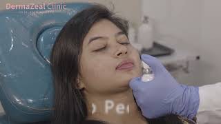 Lip Peels  Hyperpigmented lips treatment  Lip lightening peels  DermaZeal Clinic  Bangalore [upl. by Forras]