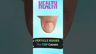 VERTICLE RIDGES on Nails The TOP Causes shorts shortsfeed ytshorts health facts [upl. by Aynor]