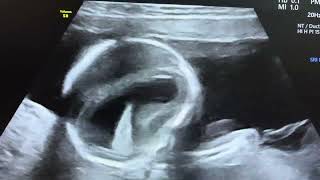 Hydrocephalus in 16 weeks fetus [upl. by Jandy58]