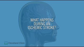 What Happens During an Ischemic Stroke [upl. by Yltneb]