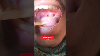 Swollen uvula यूवुला की सूजनআলাজিহবা ফুলে যাওয়া viral shortvideo [upl. by Akimas]