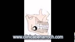 Extracción Muelas del juicio por Pericoronaritis [upl. by Althea]