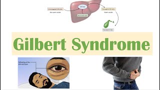 Gilbert Syndrome  Causes Genetics Pathogenesis Signs amp Symptoms Diagnosis Treatment [upl. by Fu]