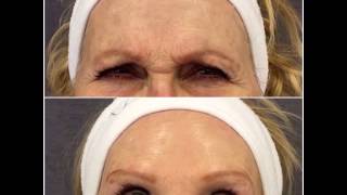 Botox  Rejuvenecimiento facial antes y después  Clinica CIME Barcelona y Badalona [upl. by Esorlatsyrc473]