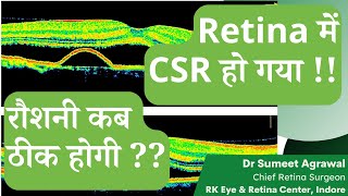 CSR RETINA में SWELLING हो गया  अब नज़र कब ठीक होगी [upl. by Acinorev]