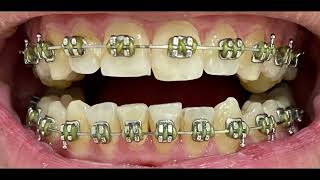 Before and After Braces timelapse over 2 Years Time monthly updates with two lower extractions [upl. by Anayad6]