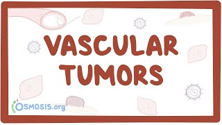 Vascular tumors kaposi hemangioma angiosarcoma  causes amp symptoms [upl. by Ellasal]